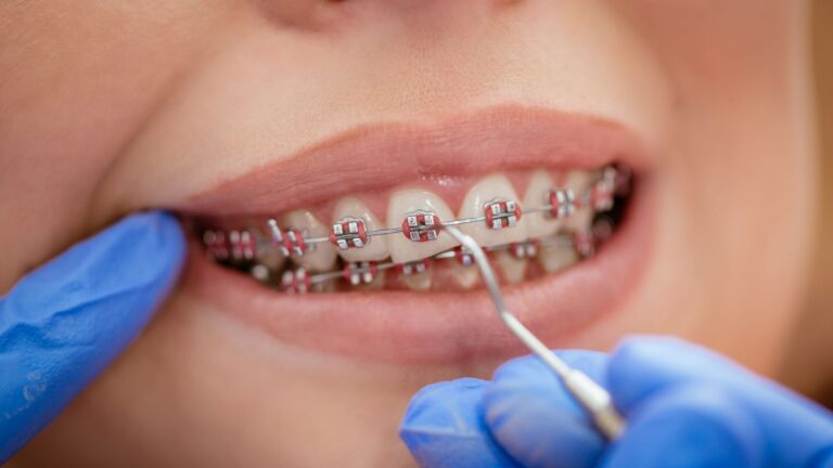 Metal braces