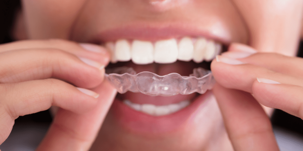 Invisalign