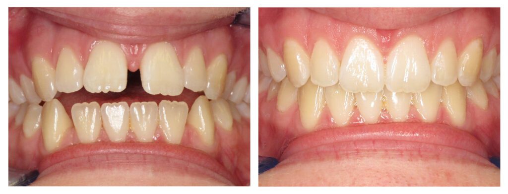 Before and After Space Closure Orthodontics